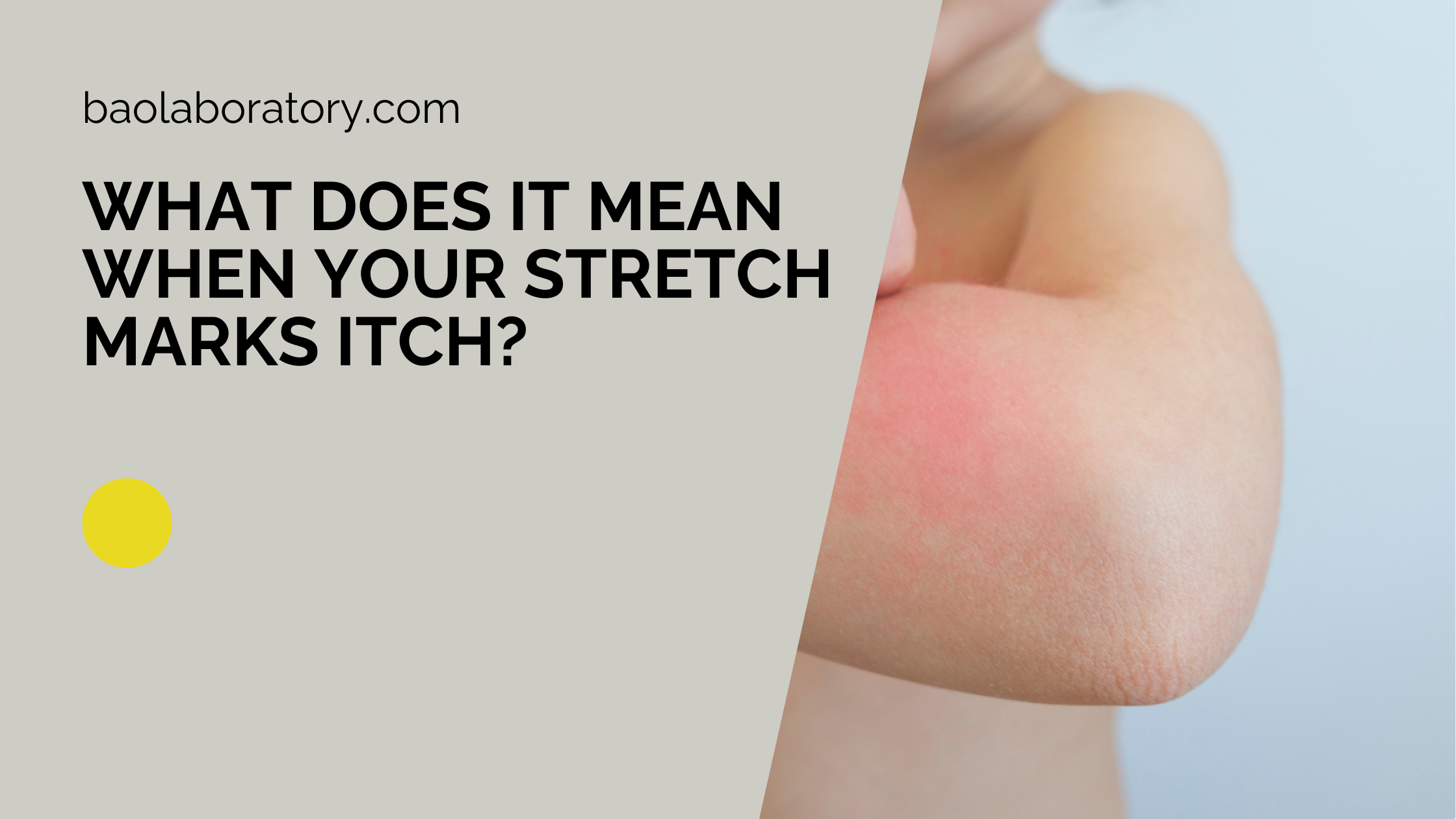 What Does It Mean When Your Stretch Marks Itch