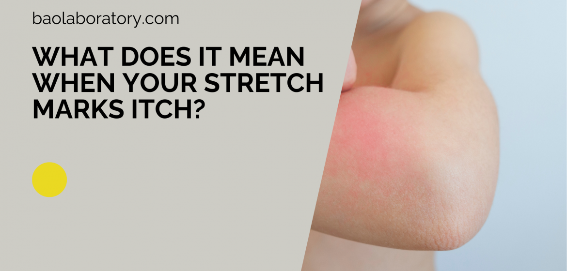What Does It Mean When Your Stretch Marks Itch